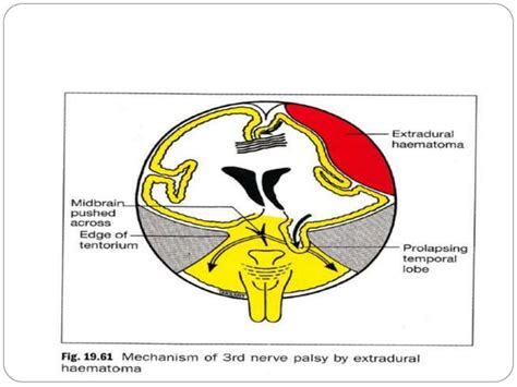 3rd nerve palsy | PPT