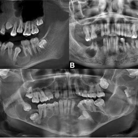 CT Scan Performed One Year After Odontogenic Keratocyst Enucleation