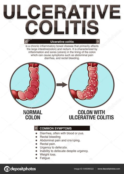 Colitis Ulcerosa S Ntomas Infograf A Ilustraci N Stock Vector By