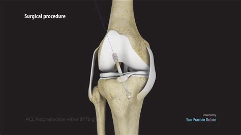 Patellar Tendon Graft