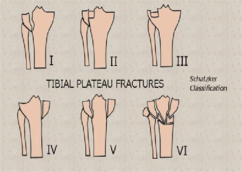 Schatzker Classification Download Scientific Diagram