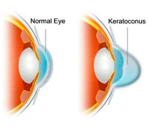 Keratoconus Surgery - ASTRAMEDICA