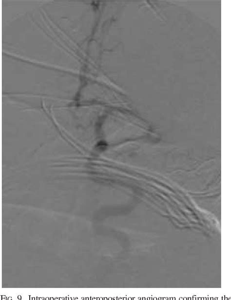 Figure 2 From Endoscopic Endonasal Clipping Of An Unsecured Superior