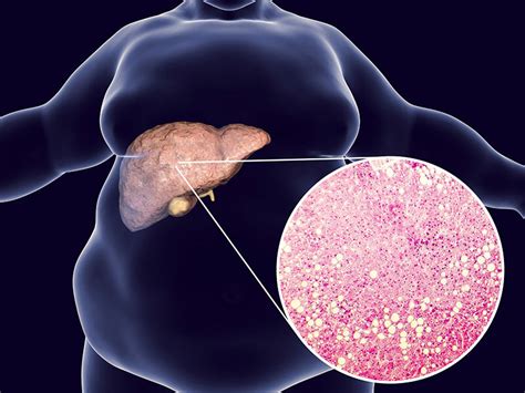 A Metabolic Approach To Nash Management Nash Treatment Cco