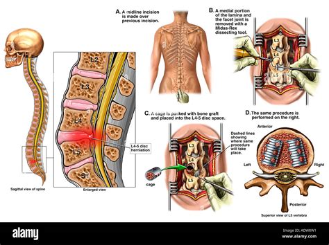 Laminectomy High Resolution Stock Photography And Images Alamy