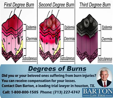 Law Info Live: Types of Burn Degrees in Civil Law Cases