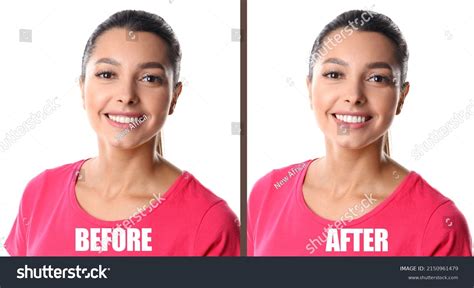 Woman Before After Gingivoplasty Procedure On Stock Photo 2150961479 ...