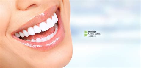 Carillas Dentales Qu Son Y Ventajas Cl Nica Dental Baldrich