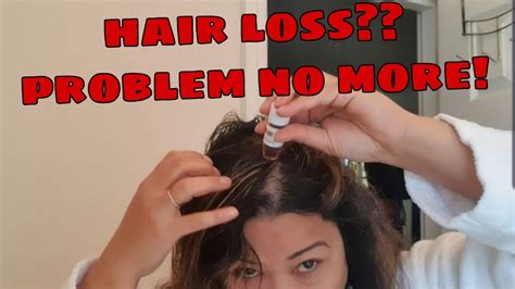 Hair Loss No More Must Watch Youtube