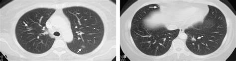 Multifocal Nodular Lymphoid Hyperplasia Of The Lung Journal Of Thoracic Imaging