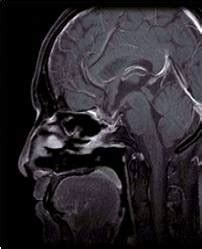 Pituitary Adenoma | Johns Hopkins Medicine