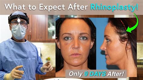 What Can I Expect During Rhinoplasty Recovery One Day To Three Weeks