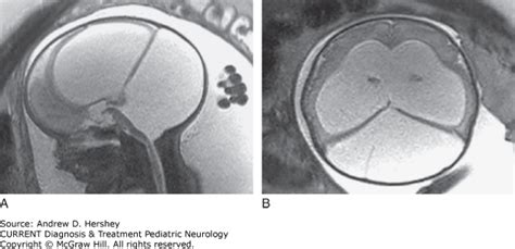 Sagittal A And Axial B T2 Single Shot Fast Spin Echo Image From