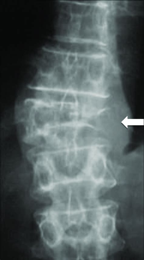 Multiple Myeloma Plain Radiograph Of Spine Shows An Osteolytic Lesion