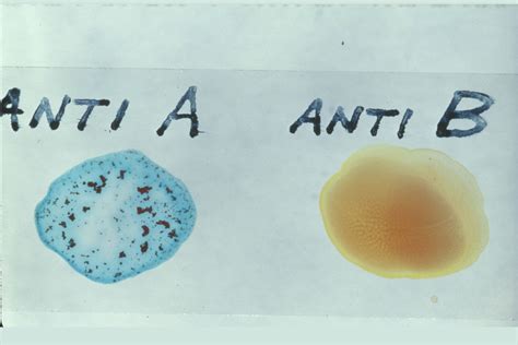 Karl Landsteiner and the Discovery of the Major Blood Types