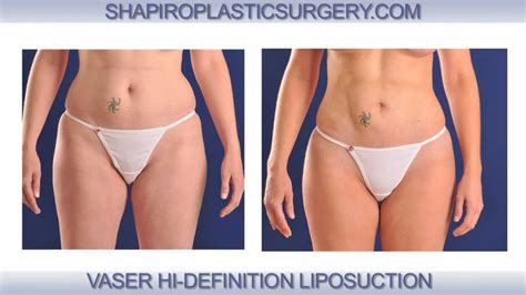 Vaser Hi Def Liposuction Procedure By Dr Shapiro In Scottsdale Arizona Youtube