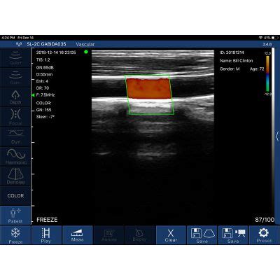 5P Linear Palm Doppler Ultrasound With Needle Guide - Sonostar ...