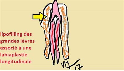 La Nymphoplastie Est Elle Un Probl Me R Cent Dr Vladimir Mitz