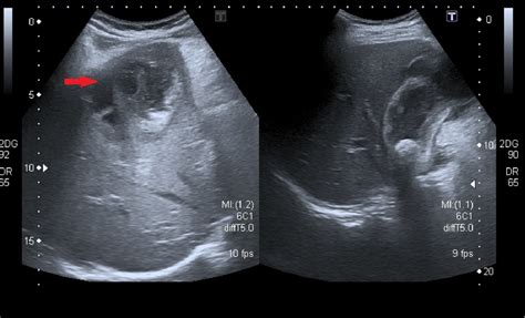 Gallbladder Perforation Radiological Aspects Types And Causes