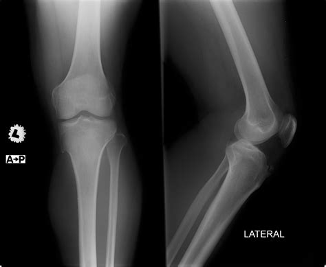 Chip Fracture Of Left Tibia Tuberosity Uni Clinic