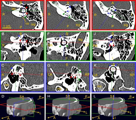 Orientation Of Human Semicircular Canals Measured By Three Dimensional Multiplanar Ct