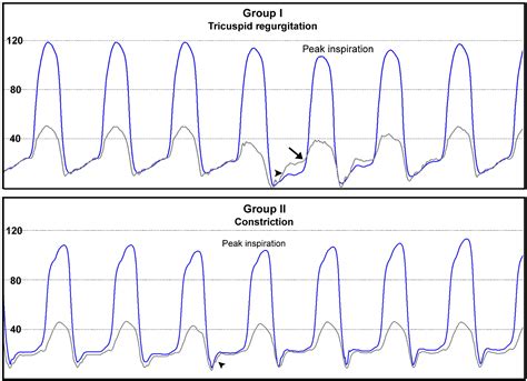 Invasive Hemodynamics Of Constrictive Pericarditis Restrictive