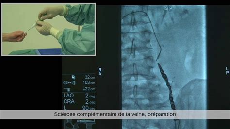 Traitement De La Varicocele Dr Toueg YouTube