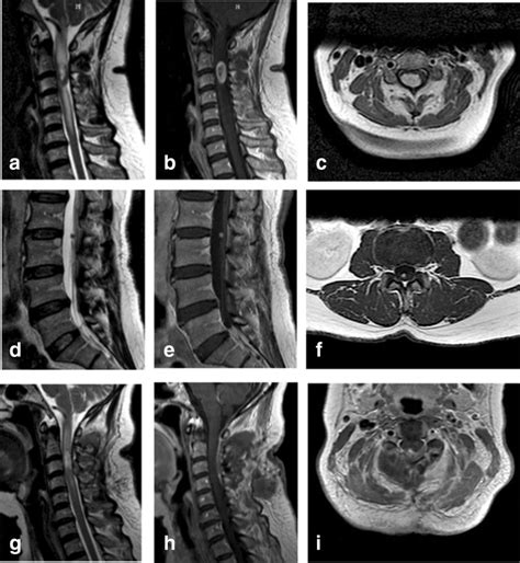 Cervical Spinal Cord Lesion Mri