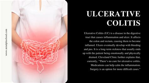 Ppt Ulcerative Colitis Diet Guide Types Treatments And Ketogenic Dietmindplusfood Powerpoint