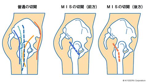 Mis（最小侵襲手術）｜関節とは 人工関節と関節痛の情報サイト 【関節が痛いcom】