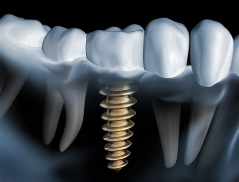 How Do You Place Dental Implants Woodland Hills Ca