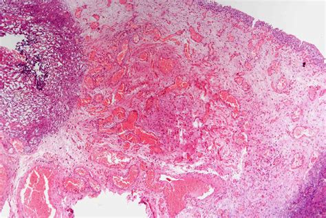 Arteriovenous Malformation Histology