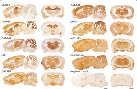 Figure 1 From Nmda Receptor Encephalitis And Other Antibody Mediated Disorders Of The Synapse