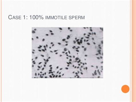 Semen Analysis In Fertility Management