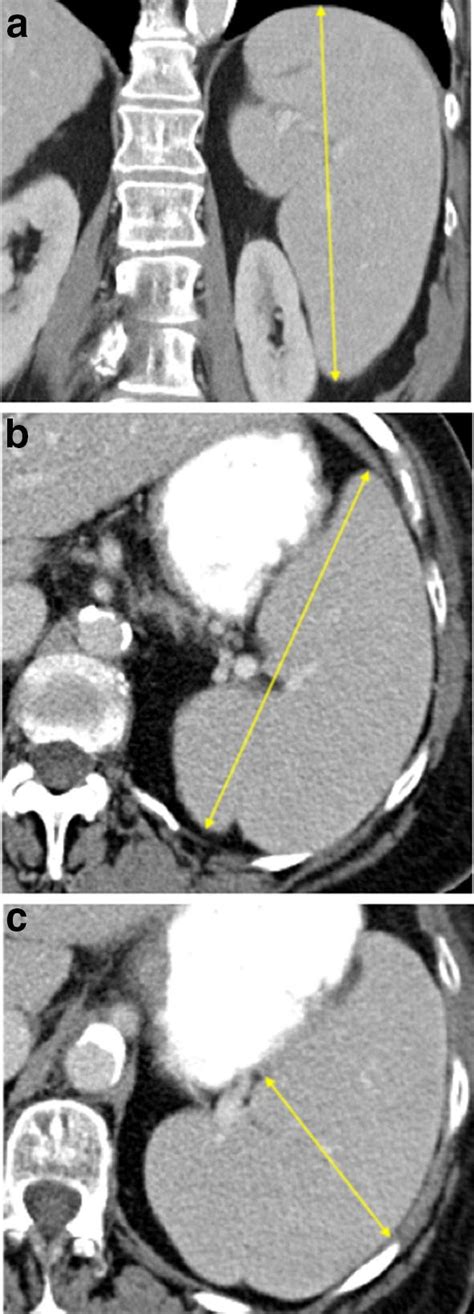 Splenomegaly Due To Portal Hypertension From Cirrhosis Download