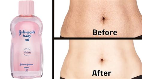 In 5 Days Remove Stretch Marks Completely Worlds Best Remedy For