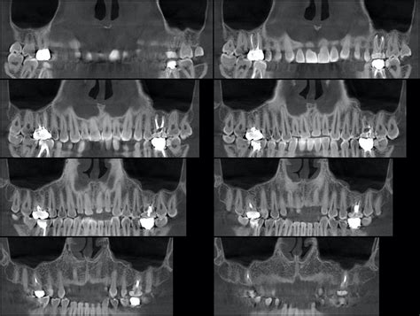 Cone Beam Ou Scanner Dentaire The Best Picture Of Beam