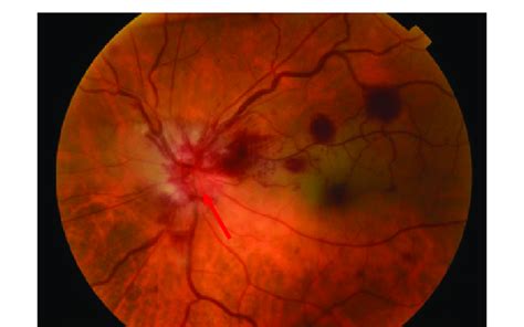 Fundus photography 3 days after first examination showed papillary... | Download Scientific Diagram