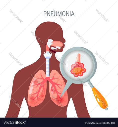 Pneumonia Disease Icon In Flat Style Royalty Free Vector