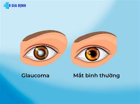 M C M N C Glaucoma B Nh Vi N A Khoa Gia Nh