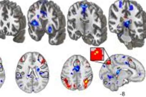 The Most Detailed Look Yet at the Neuroscience of Placebo Effects - Neuroscience News