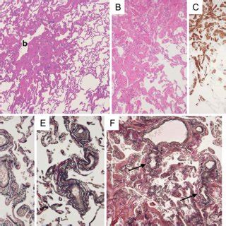 Figure4 Microscopic Findings Of The Lower Lobes Of The Lungs A The