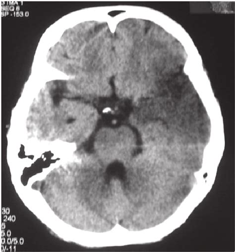 CT brain scan of Patient 5 showing large left opercular infarct and a... | Download Scientific ...