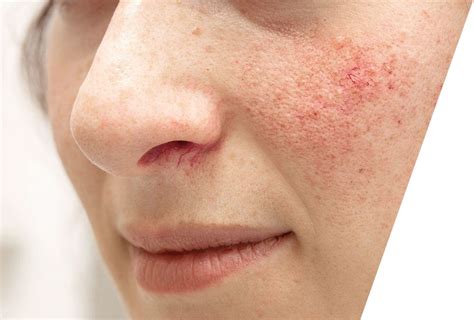 Differences Between Rosacea And Acne Anjali Mahto London