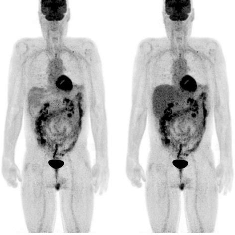 Maximum Intensity Projections Of Native Left And Corrected Whole Body