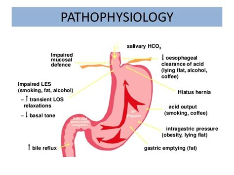 Gastroesophageal Reflux Disease