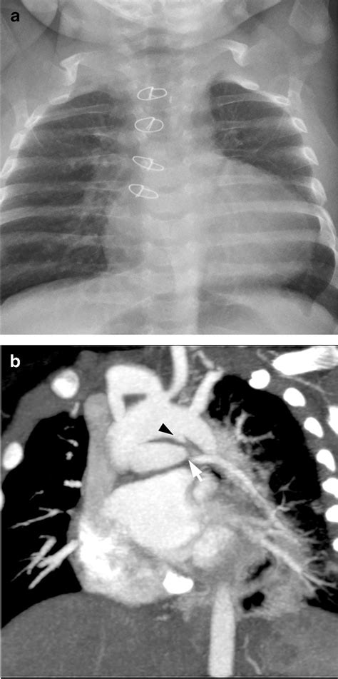 Severe Stenosis And Hypoplasia Of The Left Pulmonary Artery In A