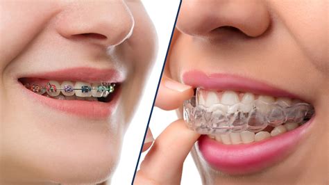 Invisalign Vs Braces Which One Is Better Right For You