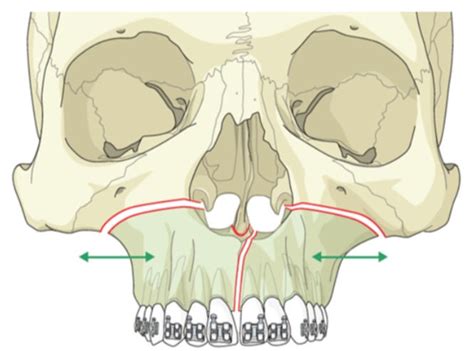 All About Palatal Expansion! Adult Orthodontics Considerations - Part Two 