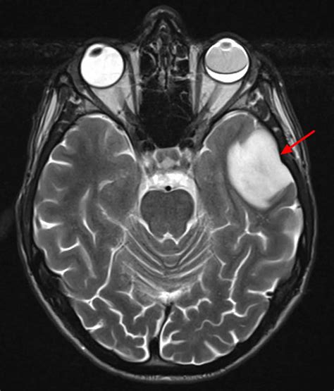 Brain lesions causes, brain lesions diagnosis and brain lesions treatment